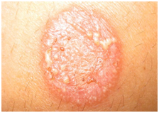  Ringworm infection - A fungal disease